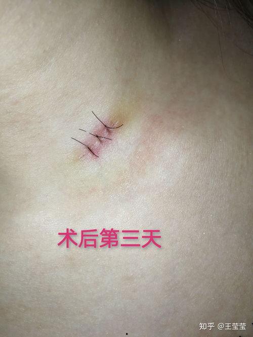 黑痣切除手术视频