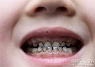 蛀牙是怎么形成的视频,从口腔健康到蛀牙的演变轨迹